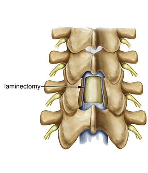 Lumbar Hemilaminectomy - Tyler Neurosurgical Associates