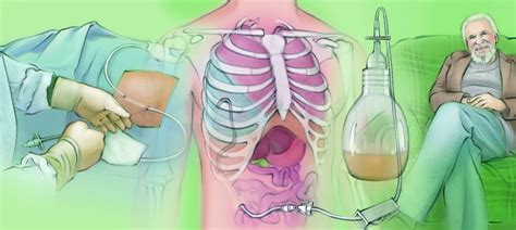 Tunneled Drainage Catheter The Interventional Initiative