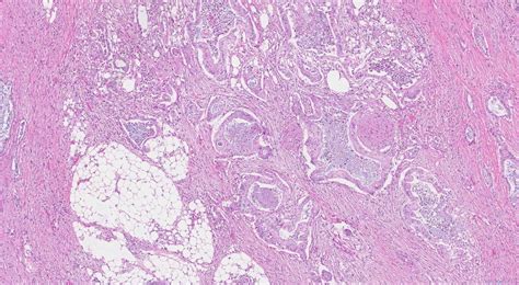 Ductal Adenocarcinoma Of The Pancreas Ottawa Atlas Of Pathology