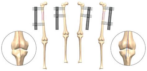 Elongaci N Sea Mediante Fi Jaci N Externa Monolateral Gu A Pr Ctica