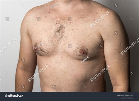Naked Man Red Pimples On His Stock Photo 2398163673 Shutterstock