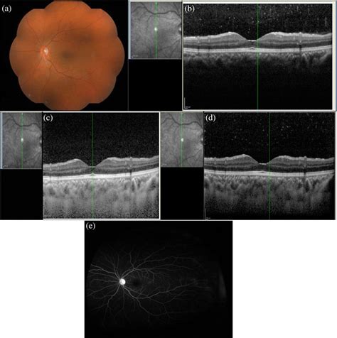 Retinal Vasculitis A The Fundus Photo Of The Left Eye Of A Patient