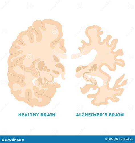 Healthy And Alzheimer Brain Neurodegeneration Concept Illustration