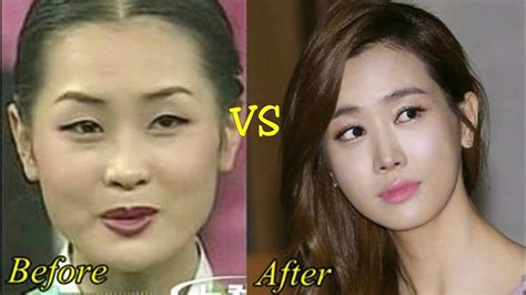 Before After Artis Korea Yang Operasi Plastik