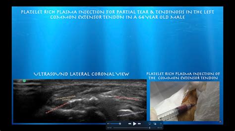 Ultrasound Guided Platelet Rich Plasma Injection For Lateral