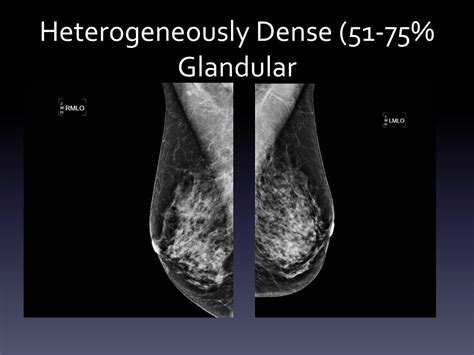 Ppt Breast Cancer Screening Whats New To Know The Issue Of Breast