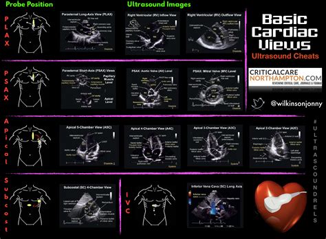 Basic POCUS Cardiac Views for Beginners : r/Foamed