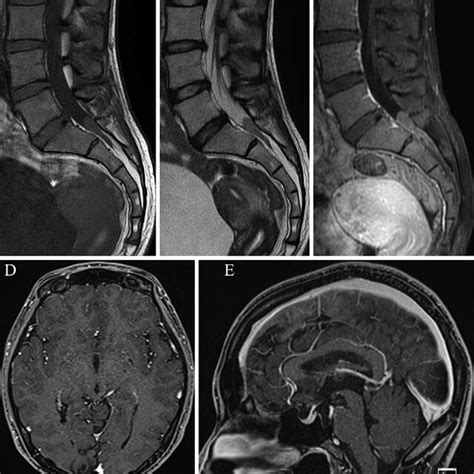 Preoperative T1 Weighted A And T2 Weighted B Mri Scans Show A Round Download Scientific