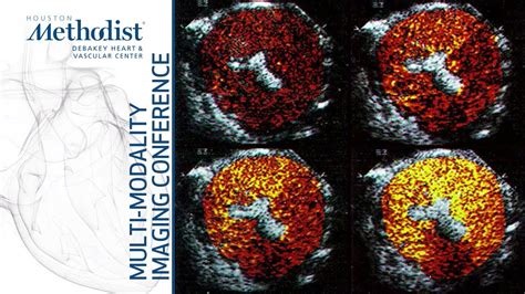 Ultrasound Enhancing Agents Current Applications And Impact William A