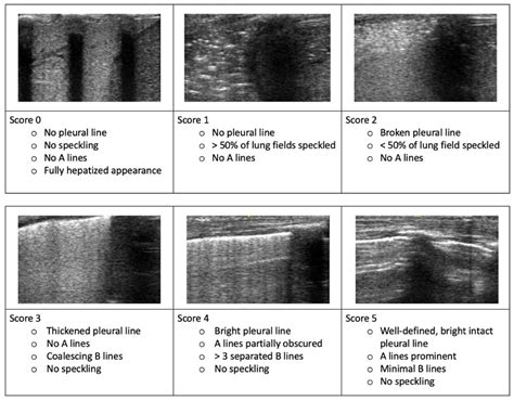 Lung Ultrasound Assessment Of Pleural Fluid And Its E
