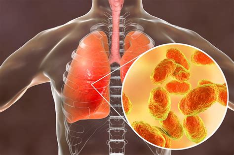 Absence Of Alveolar Neutrophilia Predictive Of Negative Bacterial