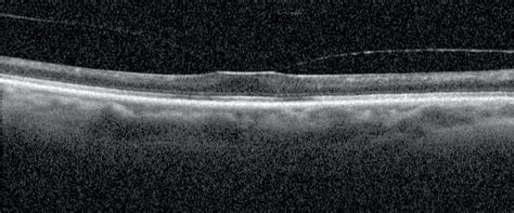 Moran Core Posterior Vitreous Detachment