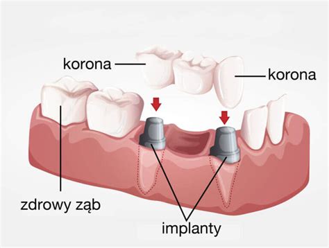 Korona Porcelanowa Ceny Mediraty