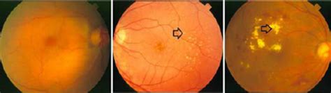 A Healthy Retina B Retina Containing Drusen C Retina Containing
