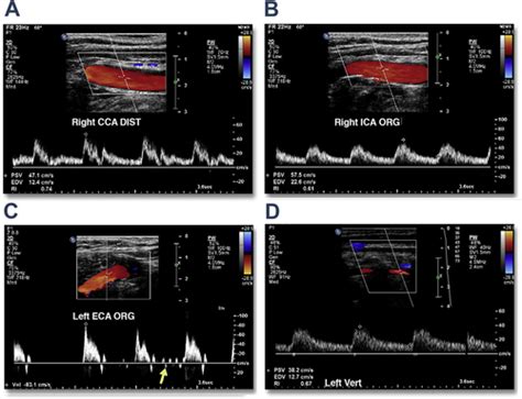 Carotid Doppler Ultrasound