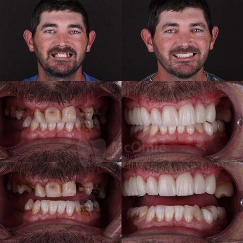 Complete Smile Transformation Full Mouth Reconstruction Chaffee History