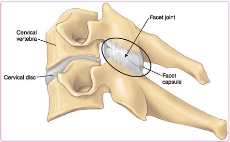 How Do You Treat Facet Joint Irritation Blackberry Clinic