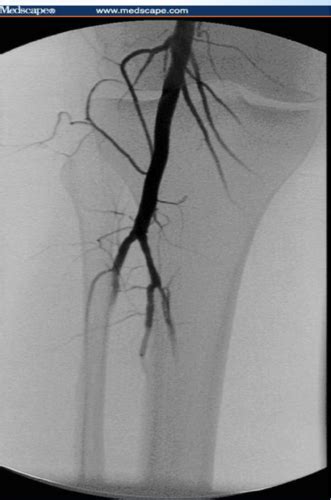 Interventional Radiology Flashcards Quizlet