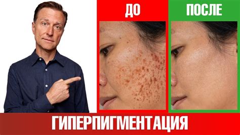 Старческие пятна на руках - как избавиться и как вывести на лице ...