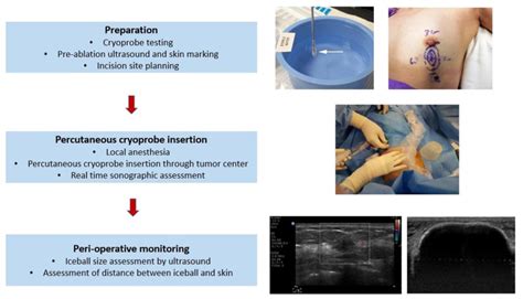 Schematic representation of the cryosurgery procedure in breast cancer ...