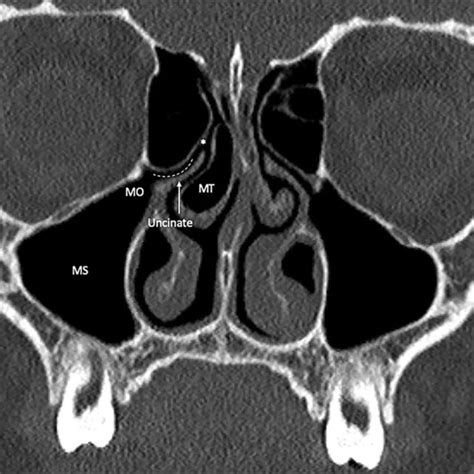 Sphenoid Sinus Development In A 21 Year Old Man A B Sagittal A And