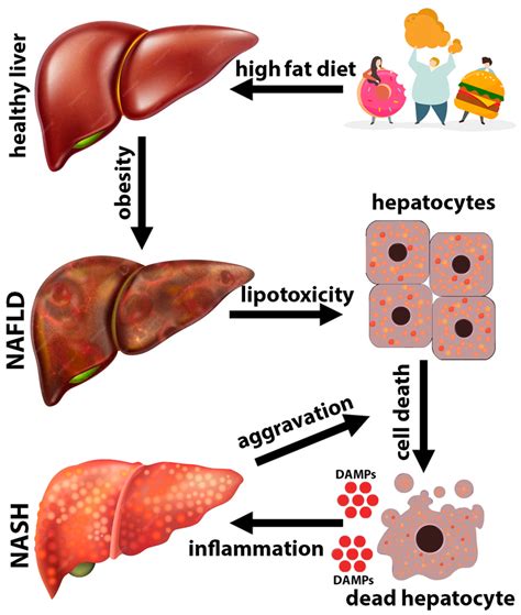 Activation Of Kupffer Cells In Nash Liver Damps Released By Dead