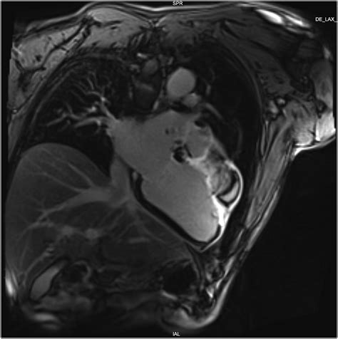 Anterior Basal Left Ventricular Pseudoaneurysm In A Single Vessel