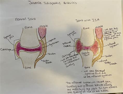 Juvenile Idiopathic Arthritis The Synovial Joint Human Steam