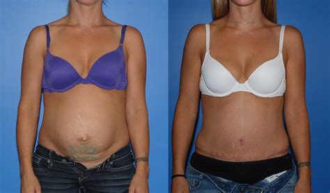 Abdominoplasty Blog Abdominoplasty Hernia Repair