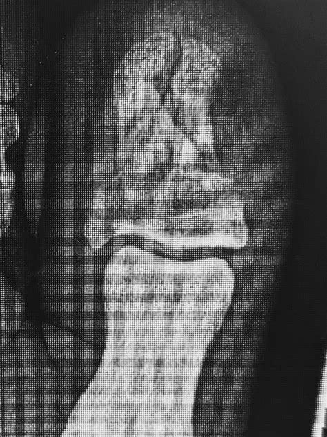 Traditional Chinese Medicine Case Report: Broken Big Toe — Alina Rehkopf