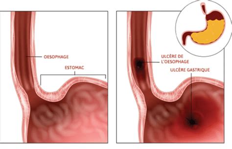 Ulc Re De Loesophage D Finition Causes Sympt Mes Diagnostic