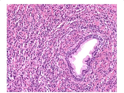 Dense Inflammatory Infiltrate With Numerous Plasma Cells Vessels Show Download Scientific