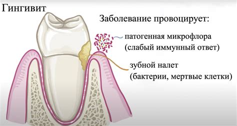 Гингивит — признаки и симптомы, формы, диагностика и лечение ...