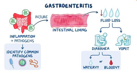 Gastroenteritis Understanding The Stomach Bug