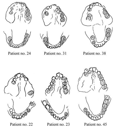 Plexiform Neurofibroma Gross