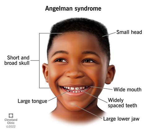 S Ndrome De Angelman