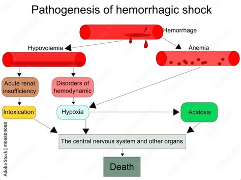 schematic pathogenesis  hemorrhagic shock stock vektorgrafik adobe