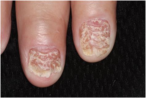 Dermatology images: Lichen planus - Journal of the American Academy of ...