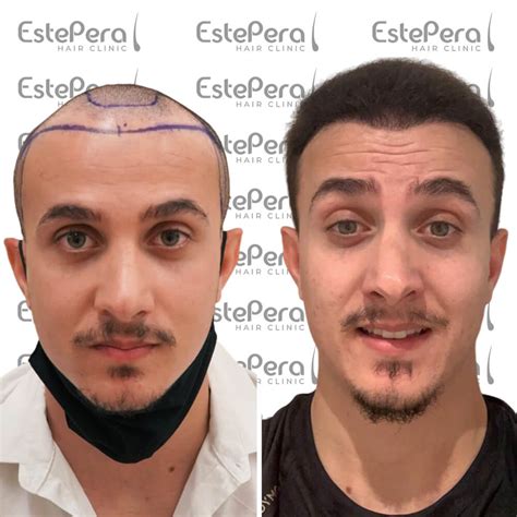 Risks And Side Effects Associated With African American Hair Transplant Archives Estepera Hair