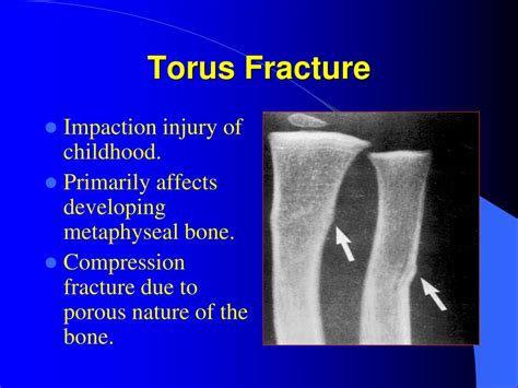 torus fracture powerpoint    id