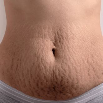 Laser Stretch Marks Removal Treatment In Dubai Abu Dhabi Cost Deals