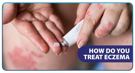 How Do You Treat Eczema - Unilab