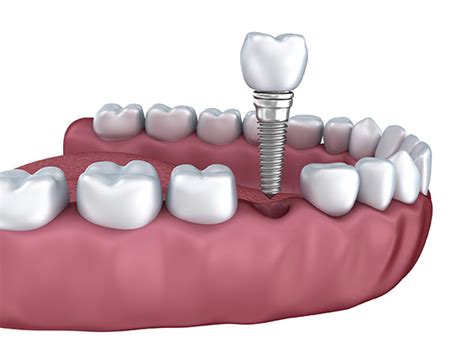 teeth implants  melbourne