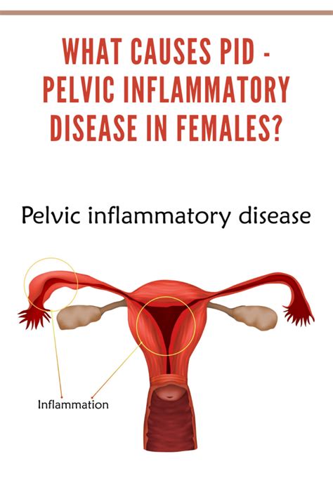 What Causes Pelvic Inflammatory Disease Moms Memo