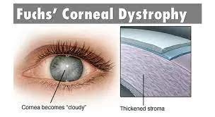 Cornea Guttata: Symptoms And Treatment | How Relate To Phaco