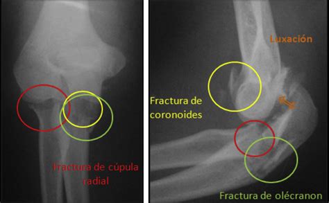 Radiografía frente y perfil de codo derecho donde está presente la