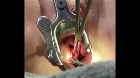 Tenir le col de l utérus avec le tenaculum pendant que le dilatateur mm baise l utérus XVIDEOS
