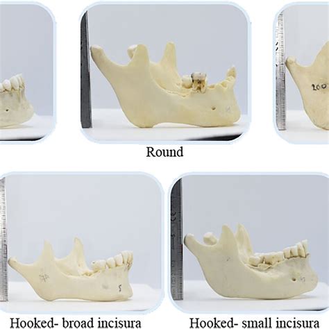 Different shapes of coronoid process. | Download Scientific Diagram