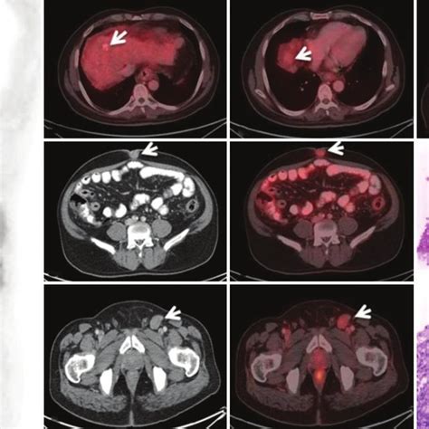 F Fluorodeoxyglucose Fdg Positron Emission Tomography Computed