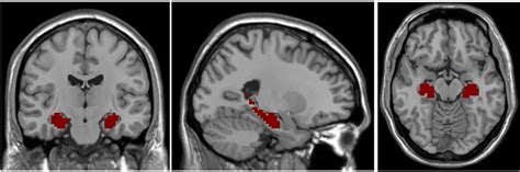 Frontiers Hippocampal Resting State Functional Connectivity In Free